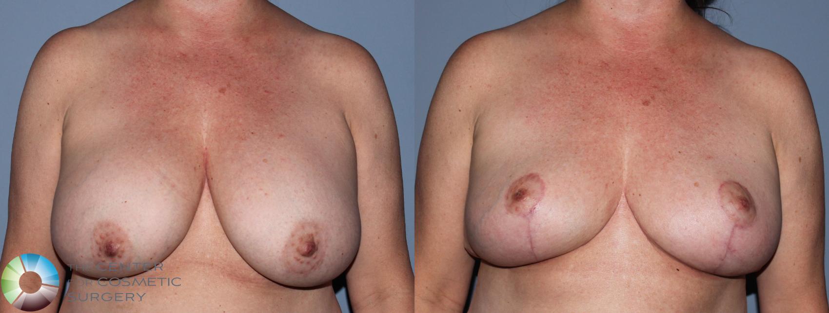 Before & After Breast Implant Revision Case 836 View #1 View in Golden, CO