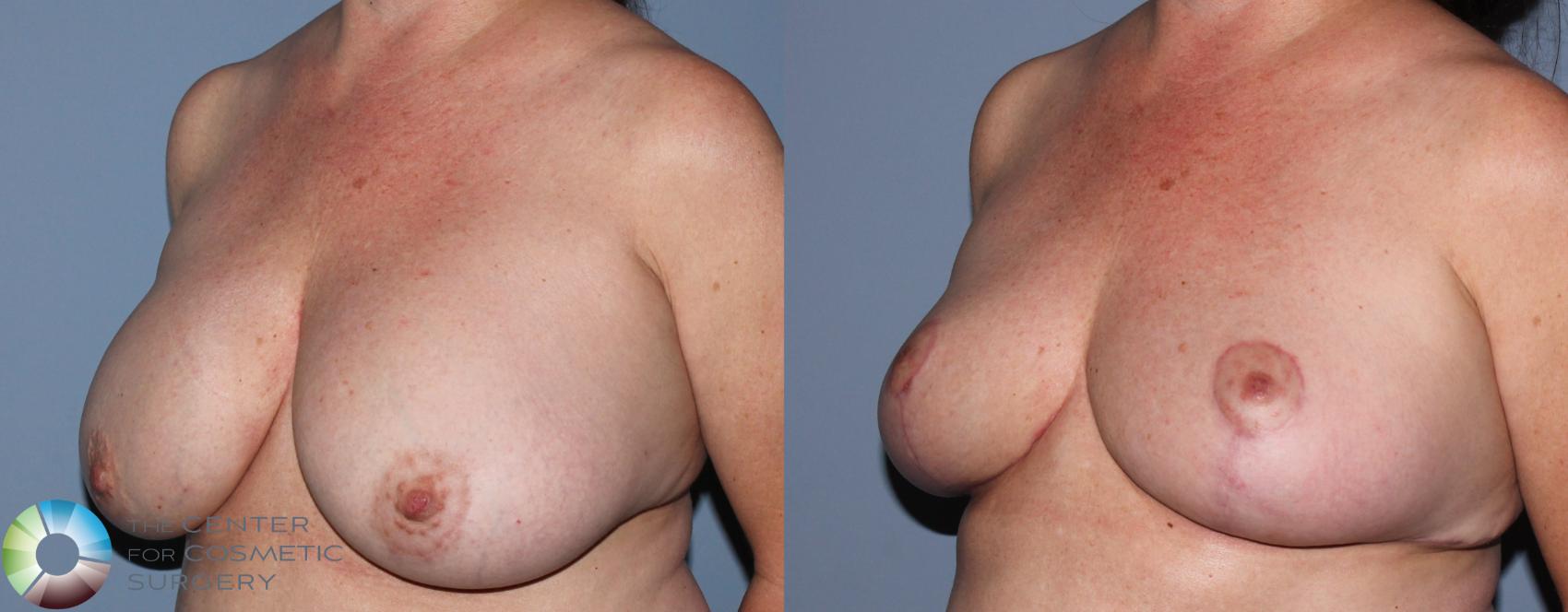 Before & After Breast Implant Revision Case 836 View #2 in Denver and Colorado Springs, CO