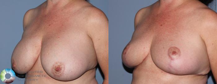 Before & After Breast Implant Revision Case 836 View #2 View in Golden, CO