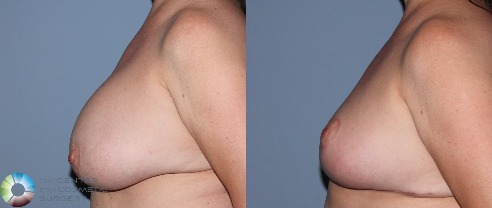Before & After Breast Implant Revision Case 836 View #3 in Denver and Colorado Springs, CO