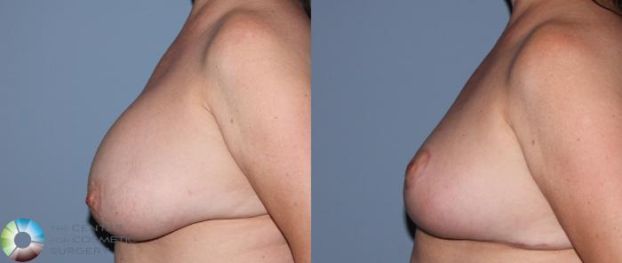 Before & After Breast Implant Revision Case 836 View #3 View in Golden, CO