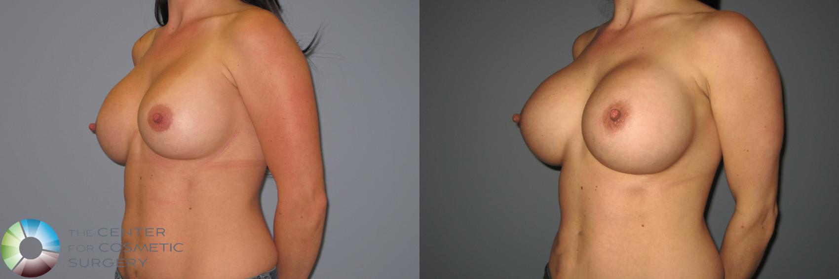 Before & After Breast Implant Revision Case 874 View #2 in Denver and Colorado Springs, CO