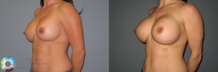 Before & After Breast Augmentation Case 874 View #2 View in Golden, CO