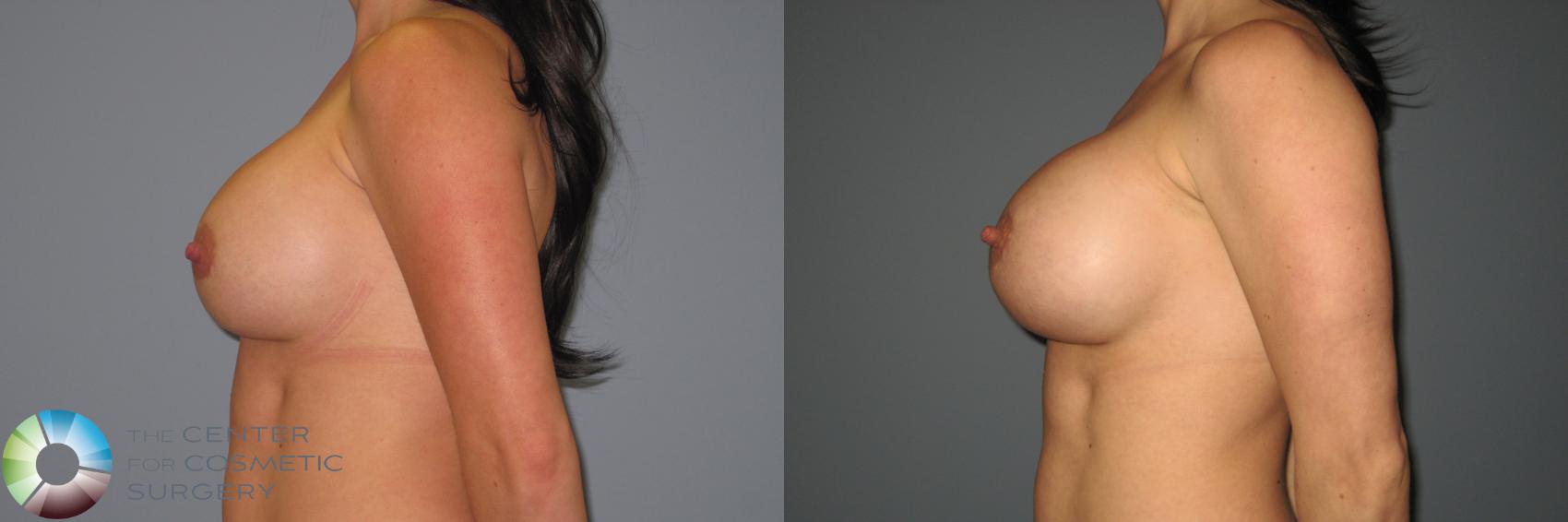 Before & After Breast Implant Revision Case 874 View #3 in Denver and Colorado Springs, CO