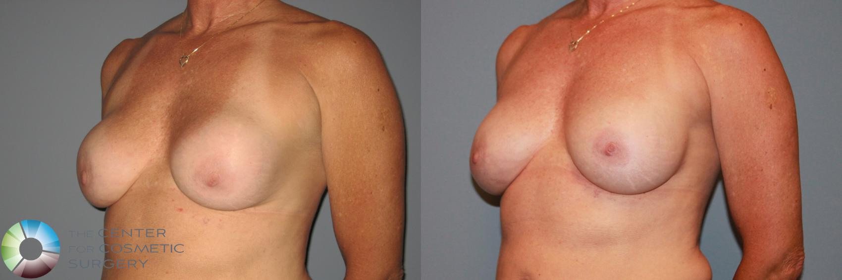 Before & After Breast Implant Revision Case 876 View #1 in Denver and Colorado Springs, CO