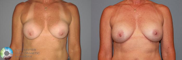 Before & After Breast Implant Revision Case 876 View #2 in Denver and Colorado Springs, CO