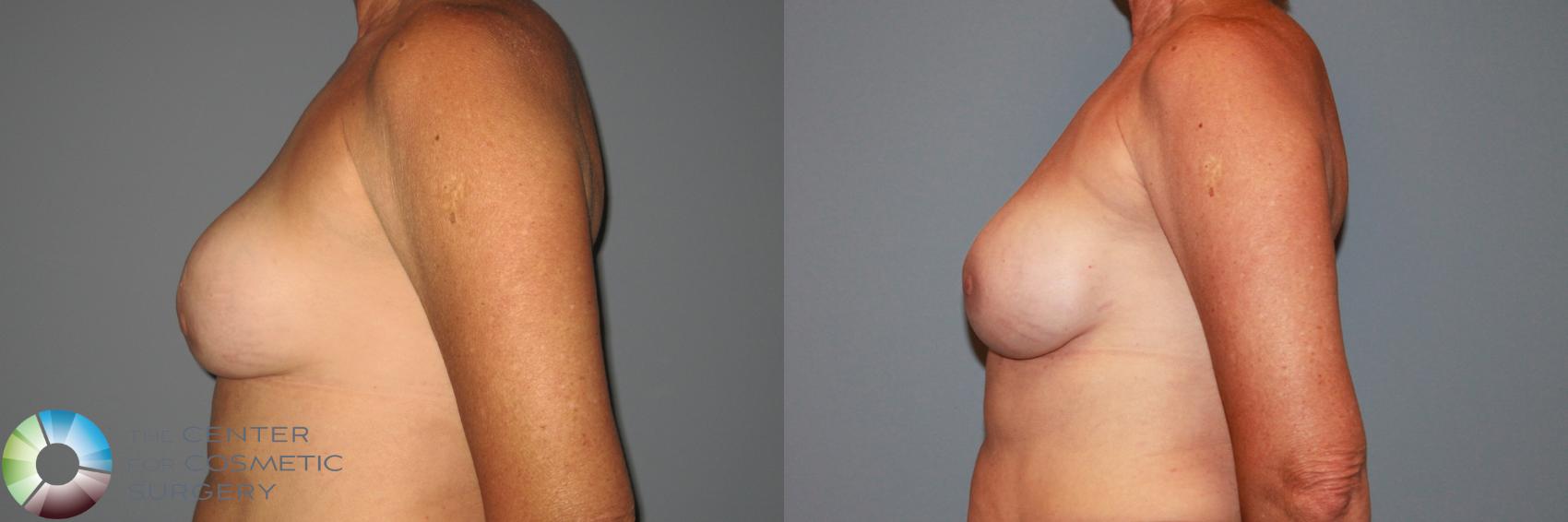 Before & After Breast Implant Revision Case 876 View #3 in Denver and Colorado Springs, CO