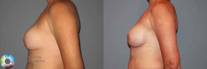 Before & After Breast Implant Revision Case 876 View #3 in Denver and Colorado Springs, CO