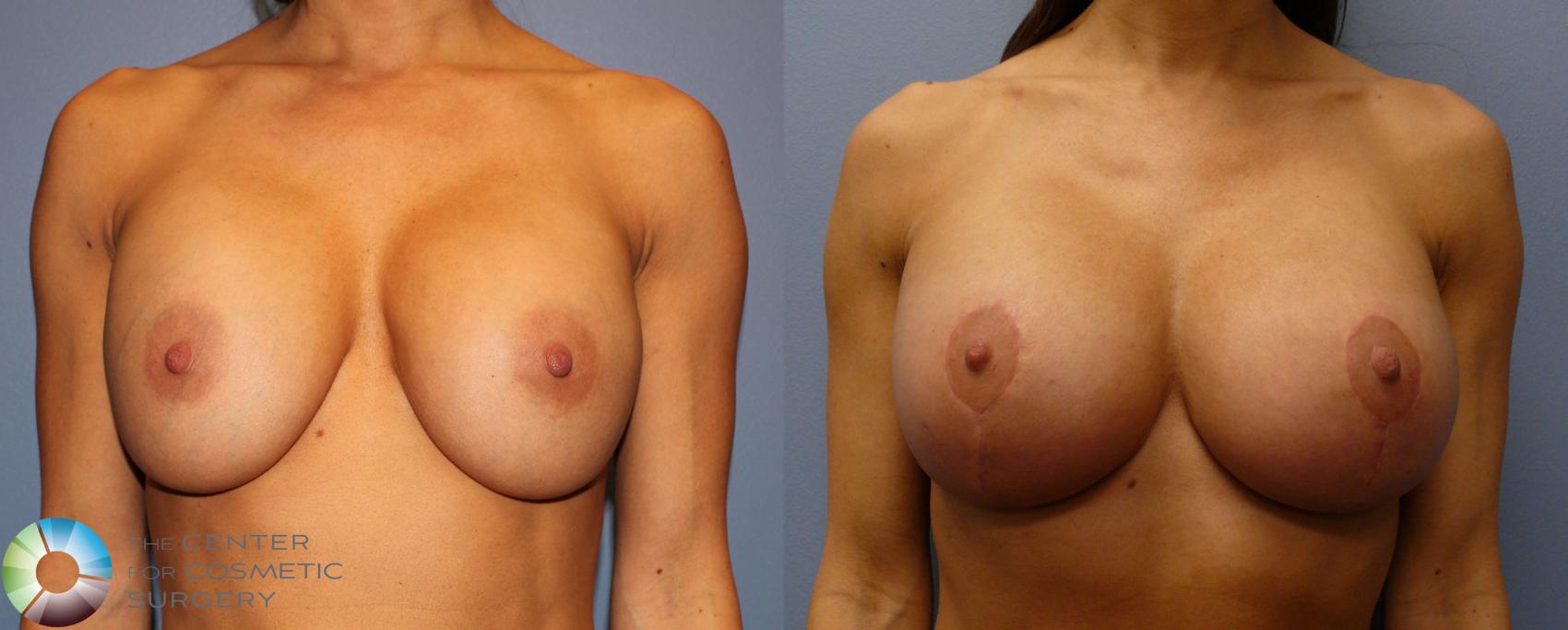 Before & After Breast Implant Revision Case 904 View #1 in Denver and Colorado Springs, CO