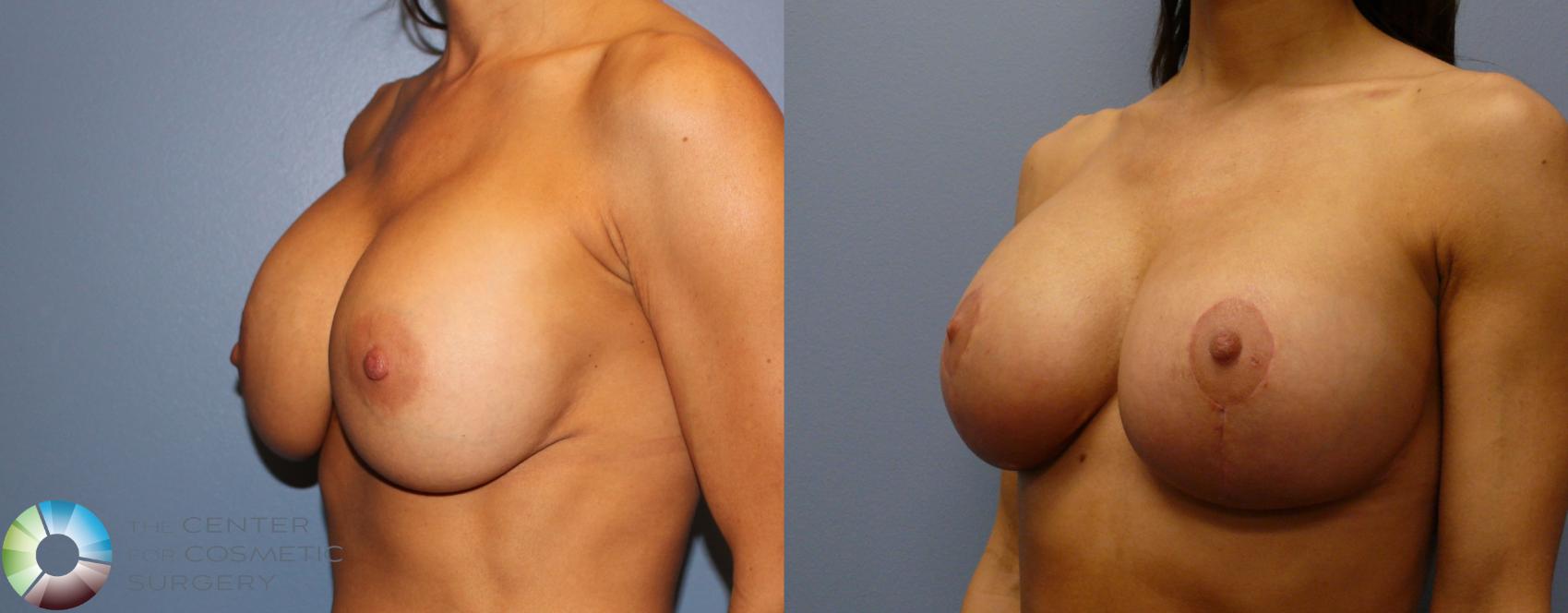 Before & After Breast Implant Revision Case 904 View #2 View in Golden, CO