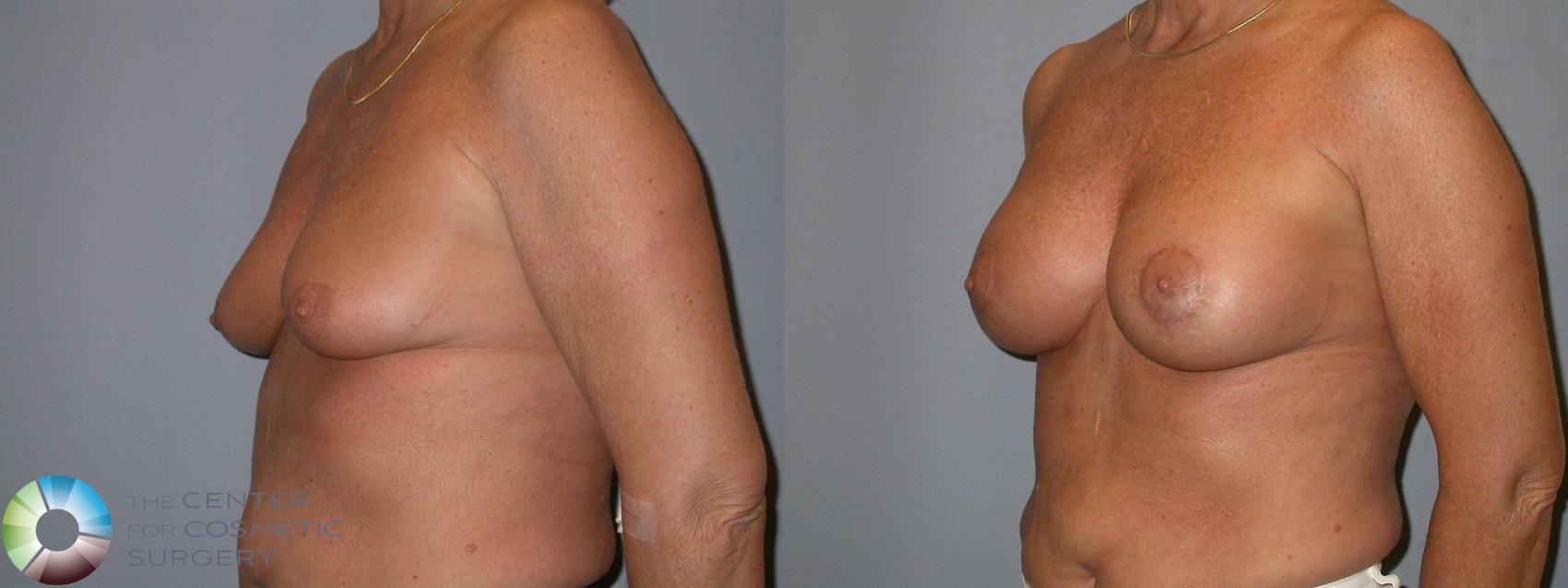 Before & After Breast Lift Case 102 View #1 in Denver and Colorado Springs, CO