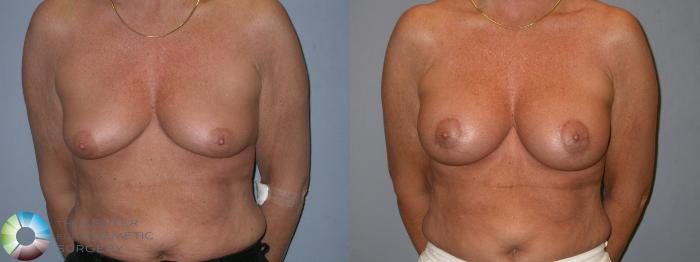 Before & After Breast Lift Case 102 View #2 in Denver and Colorado Springs, CO