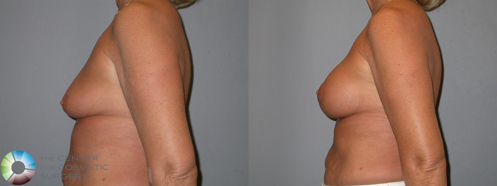 Before & After Breast Lift Case 102 View #3 in Denver and Colorado Springs, CO