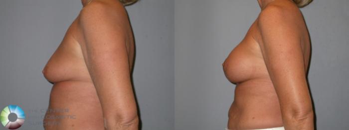 Before & After Breast Lift Case 102 View #3 in Denver and Colorado Springs, CO