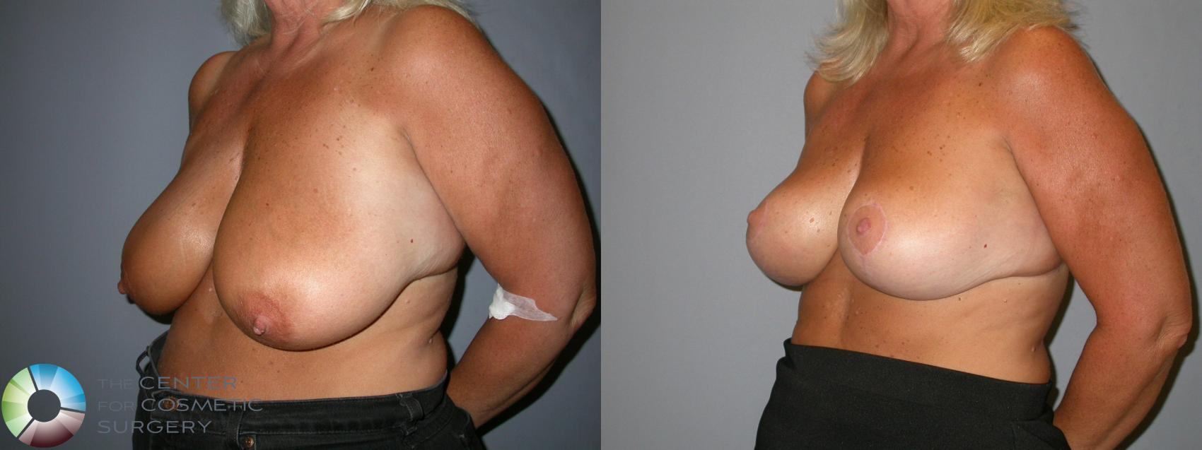 Before & After Breast Lift Case 107 View #2 in Denver and Colorado Springs, CO