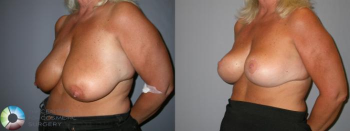 Before & After Breast Lift without Implants Case 107 View #2 View in Golden, CO