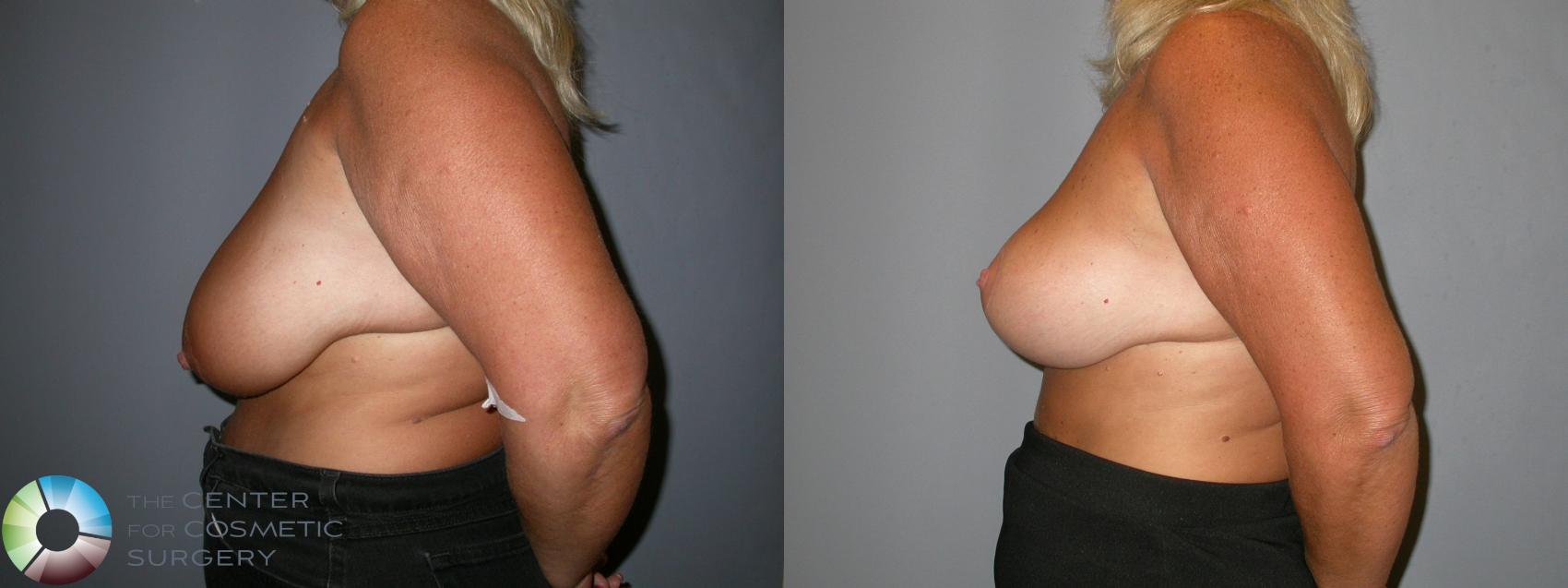 Before & After Breast Lift Case 107 View #3 in Denver and Colorado Springs, CO