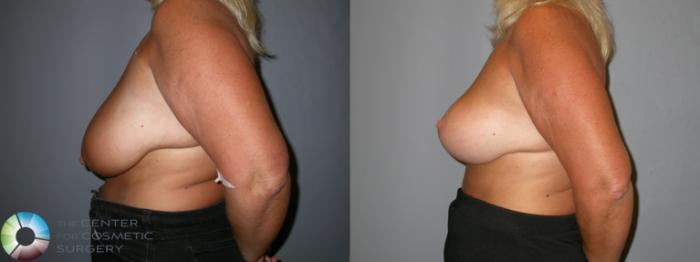 Before & After Breast Lift Case 107 View #3 View in Golden, CO