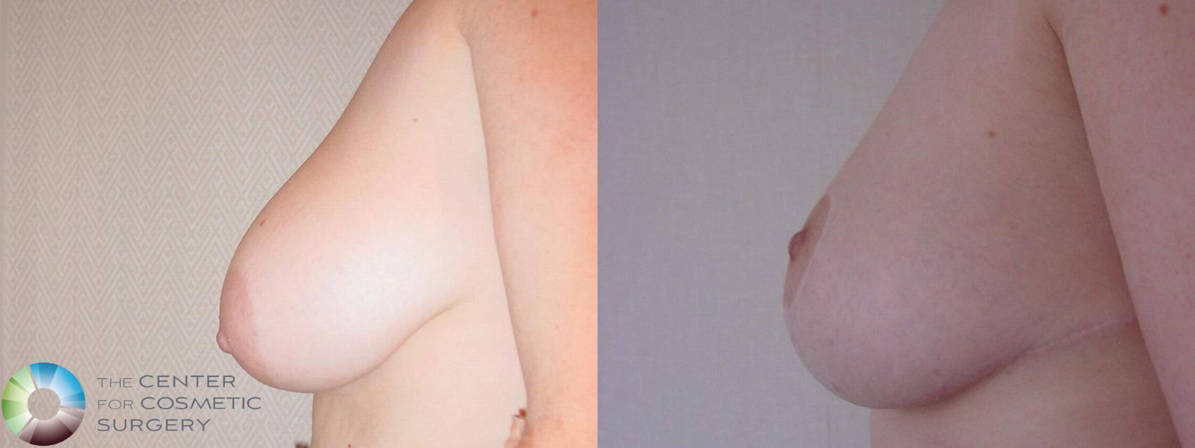 Before & After Breast Lift Case 10717 Left Side in Denver and Colorado Springs, CO
