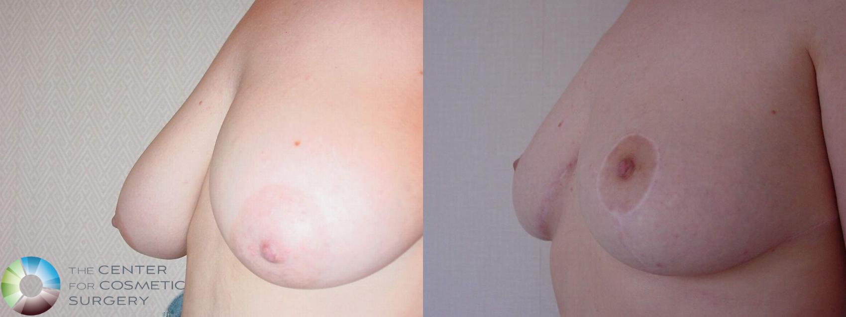 Before & After Breast Lift Case 10717 Oblique in Denver and Colorado Springs, CO