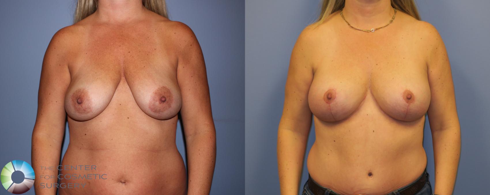 Before & After Breast Lift Case 11302 Front in Denver and Colorado Springs, CO