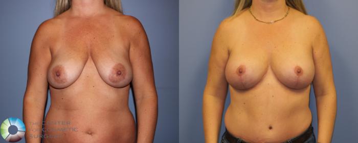 Before & After Breast Lift Case 11302 Front View in Golden, CO