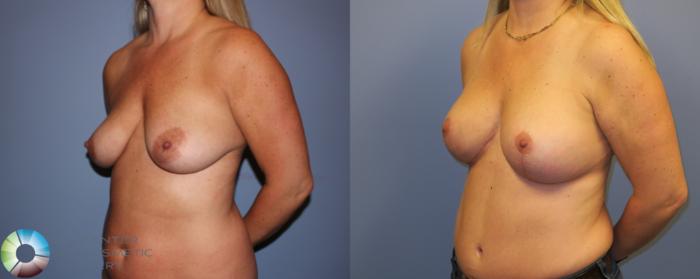 Before & After Breast Lift Case 11302 Left Oblique View in Golden, CO
