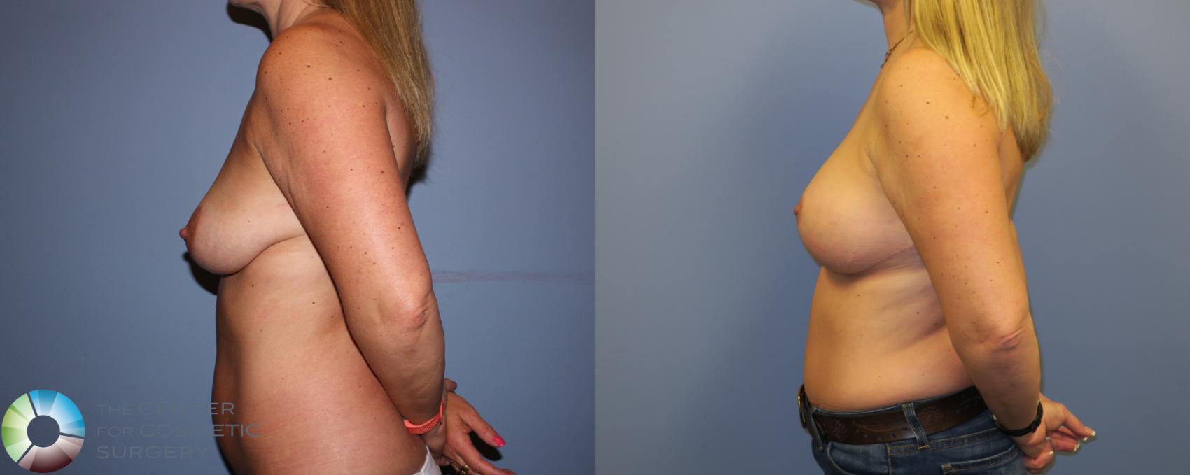 Before & After Breast Lift Case 11302 Left Side in Denver and Colorado Springs, CO