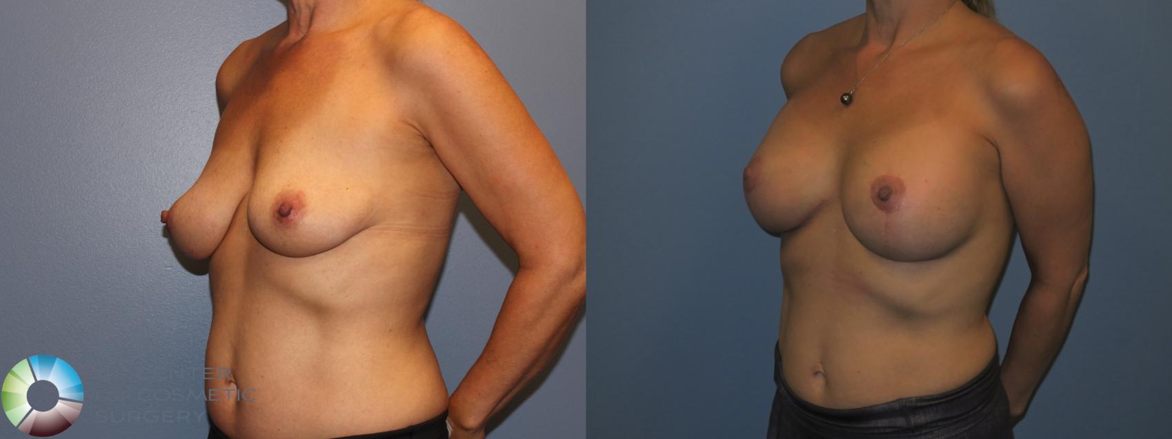 Before & After Breast Lift Case 11308 Left Oblique in Denver and Colorado Springs, CO