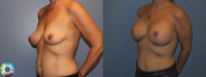 Before & After Breast Lift Case 11308 Left Oblique View in Golden, CO