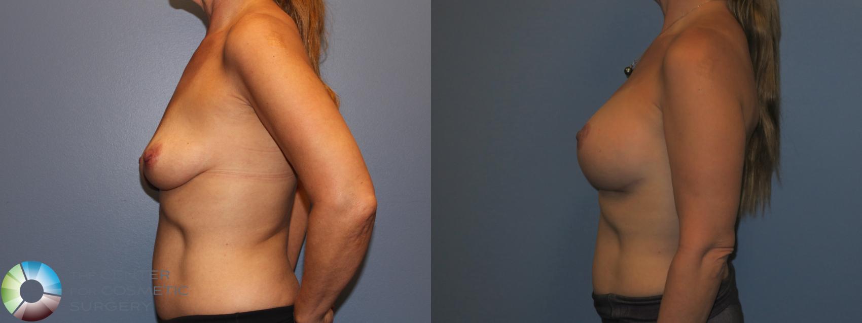 Before & After Breast Lift Case 11308 Left Side in Denver and Colorado Springs, CO