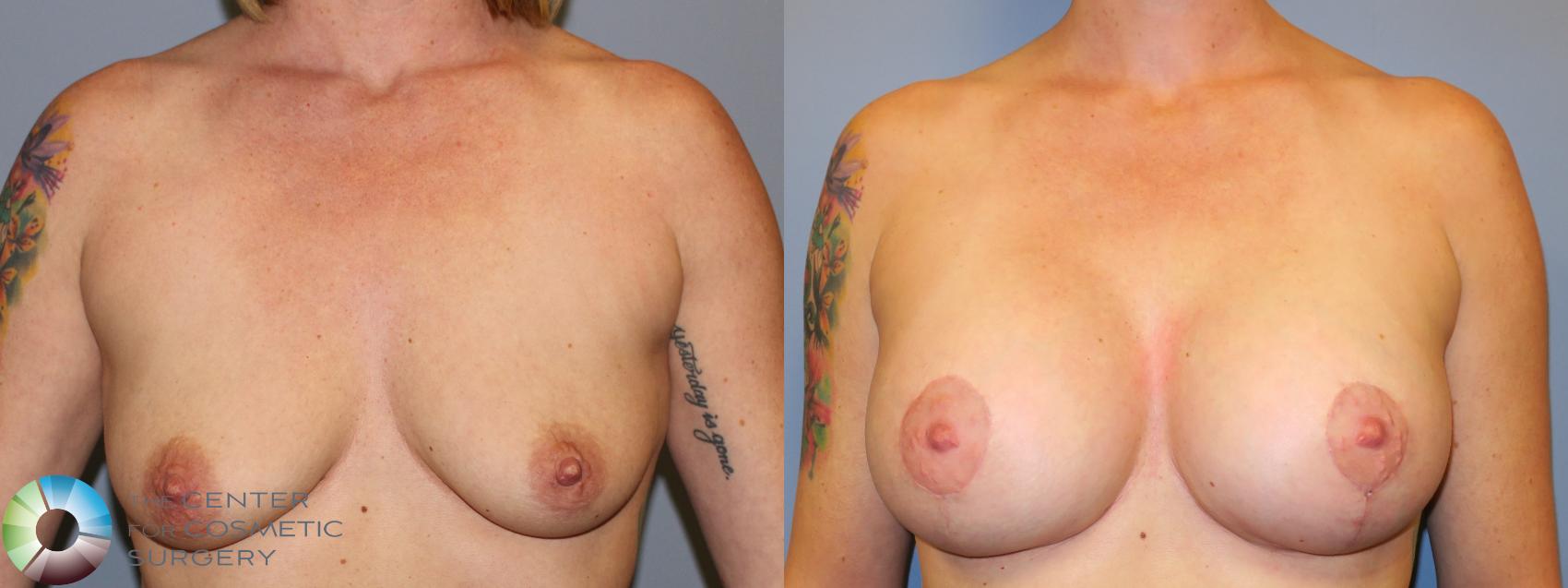 Best Denver Breast Lift/Augmentation
