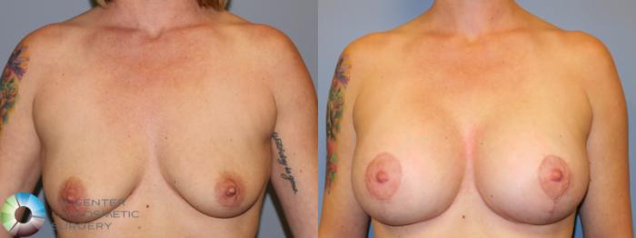 Before & After Breast Lift Case 11321 Front in Denver and Colorado Springs, CO