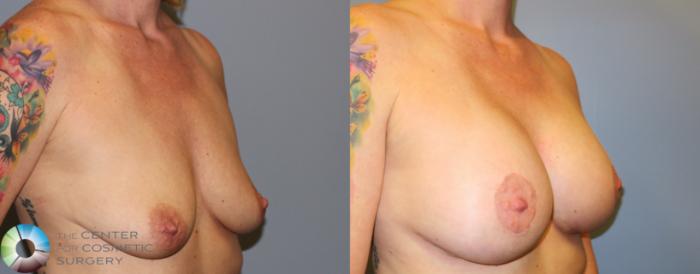 Before & After Breast Augmentation Case 11321 Right Oblique in Denver and Colorado Springs, CO