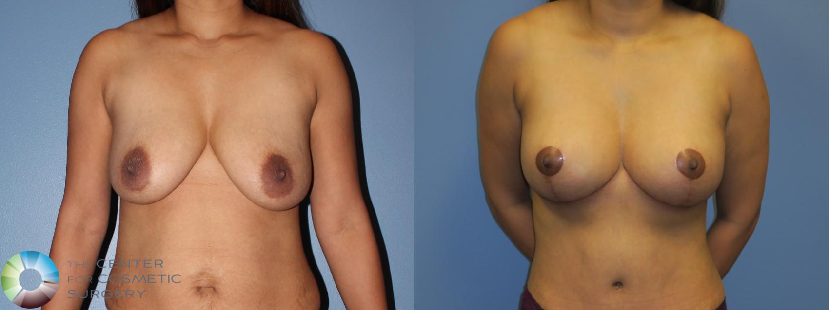 Before & After Breast Lift Case 11378 Front in Denver and Colorado Springs, CO