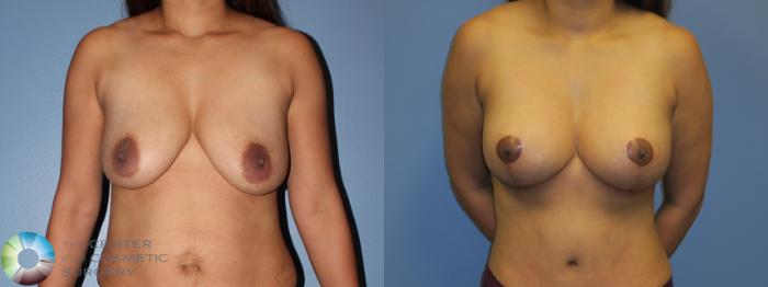 Before & After Breast Lift Case 11378 Front View in Golden, CO
