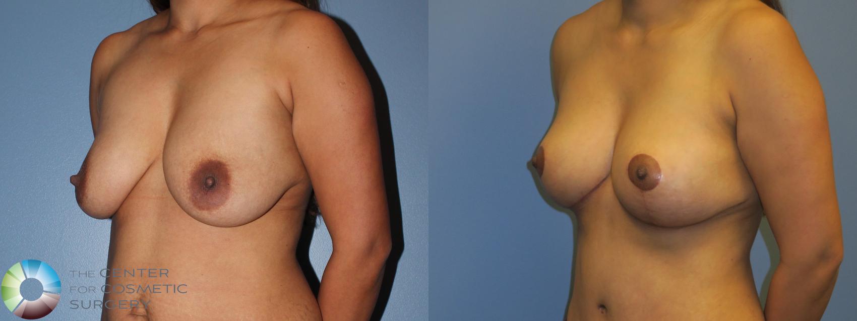 Before & After Breast Lift Case 11378 Left Oblique View in Golden, CO