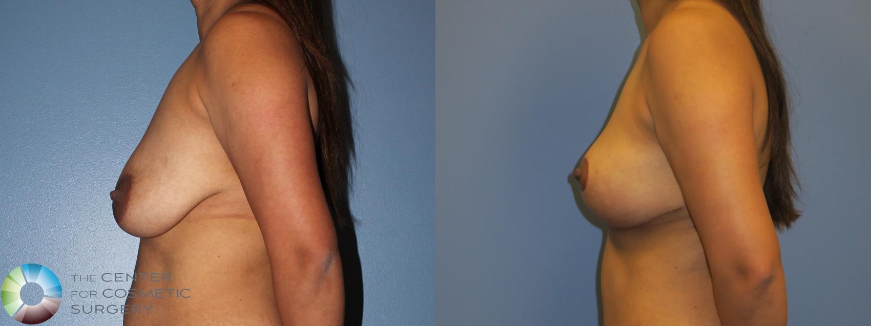 Before & After Breast Lift Case 11378 Left Side View in Golden, CO