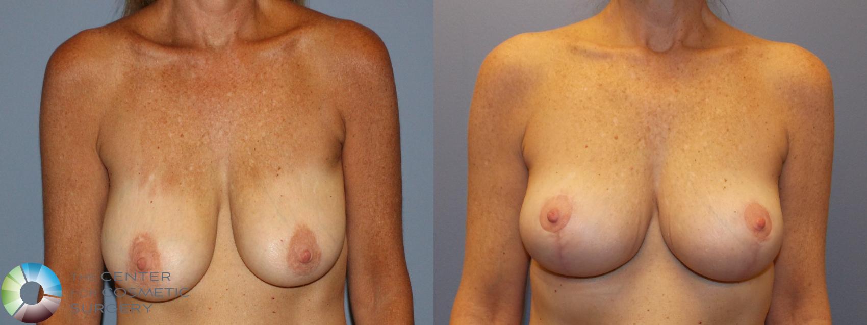 Before & After Breast Lift without Implants Case 11508 Front View in Golden, CO