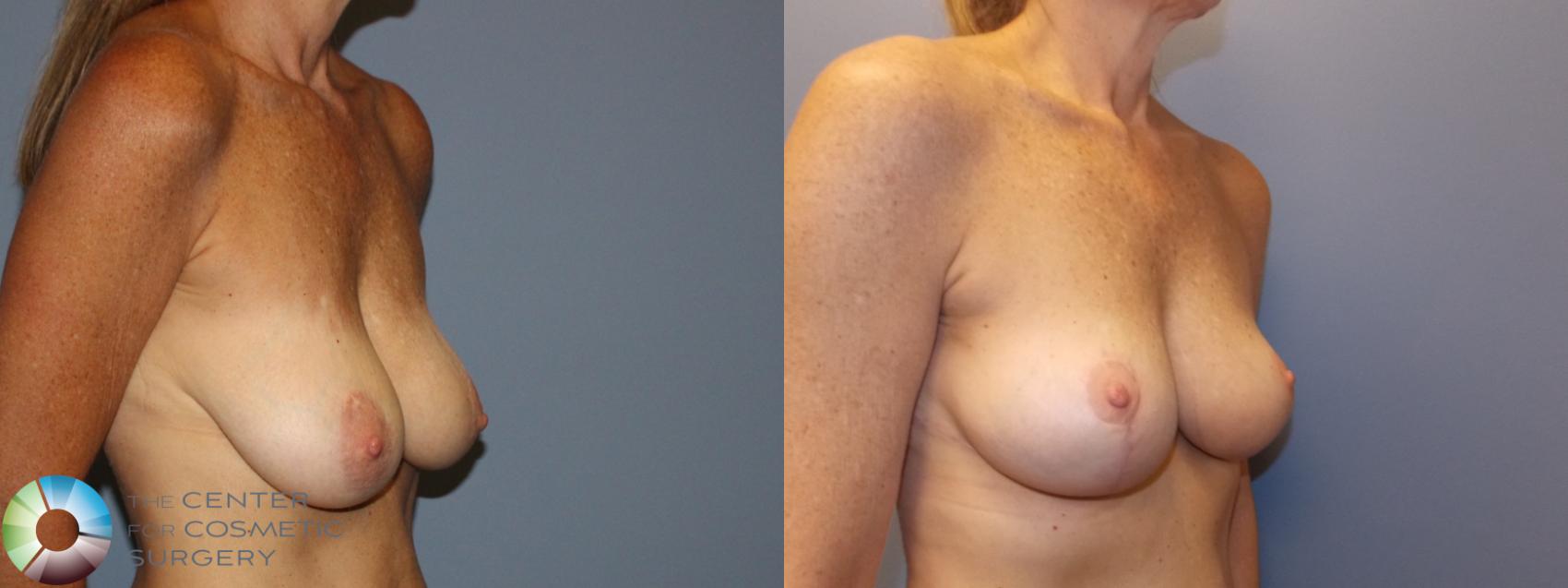 Best Denver Breast Reduction Lift