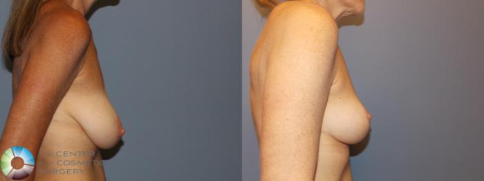 Before & After Breast Lift without Implants Case 11508 Right Side View in Golden, CO