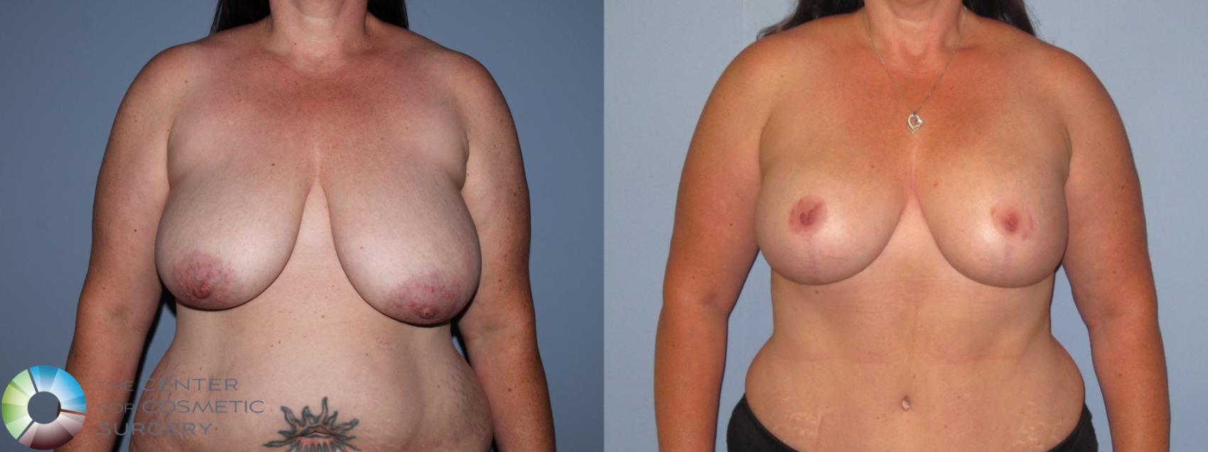 Before & After Breast Lift Case 11511 Front in Denver and Colorado Springs, CO
