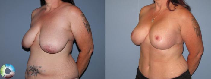 Before & After Breast Lift Case 11511 Left Oblique in Denver and Colorado Springs, CO