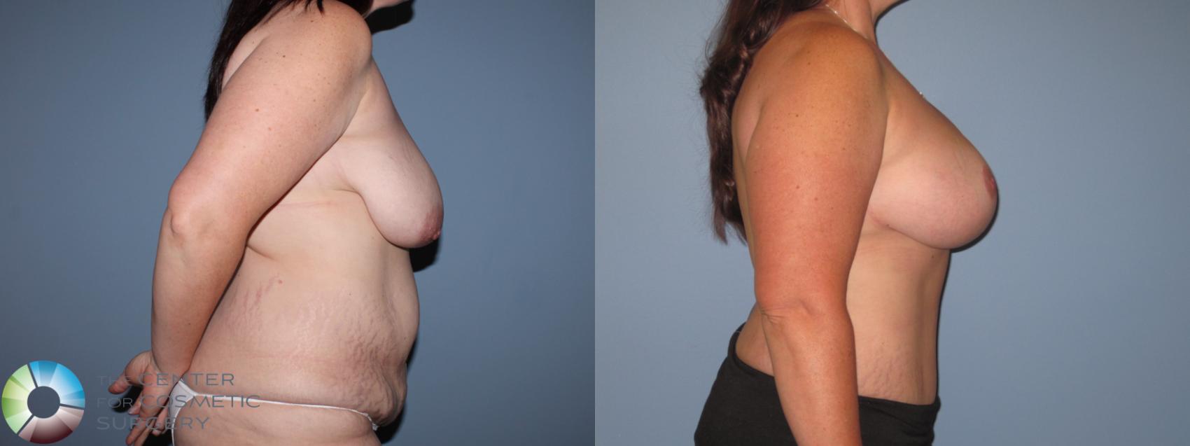 Before & After Breast Lift Case 11511 Right Side in Denver and Colorado Springs, CO