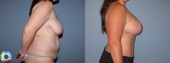 Before & After Breast Lift Case 11511 Right Side in Denver and Colorado Springs, CO
