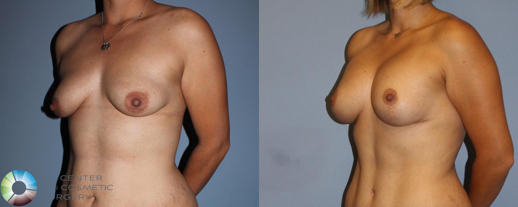 Before & After Breast Lift Case 11513 Left Oblique View in Golden, CO