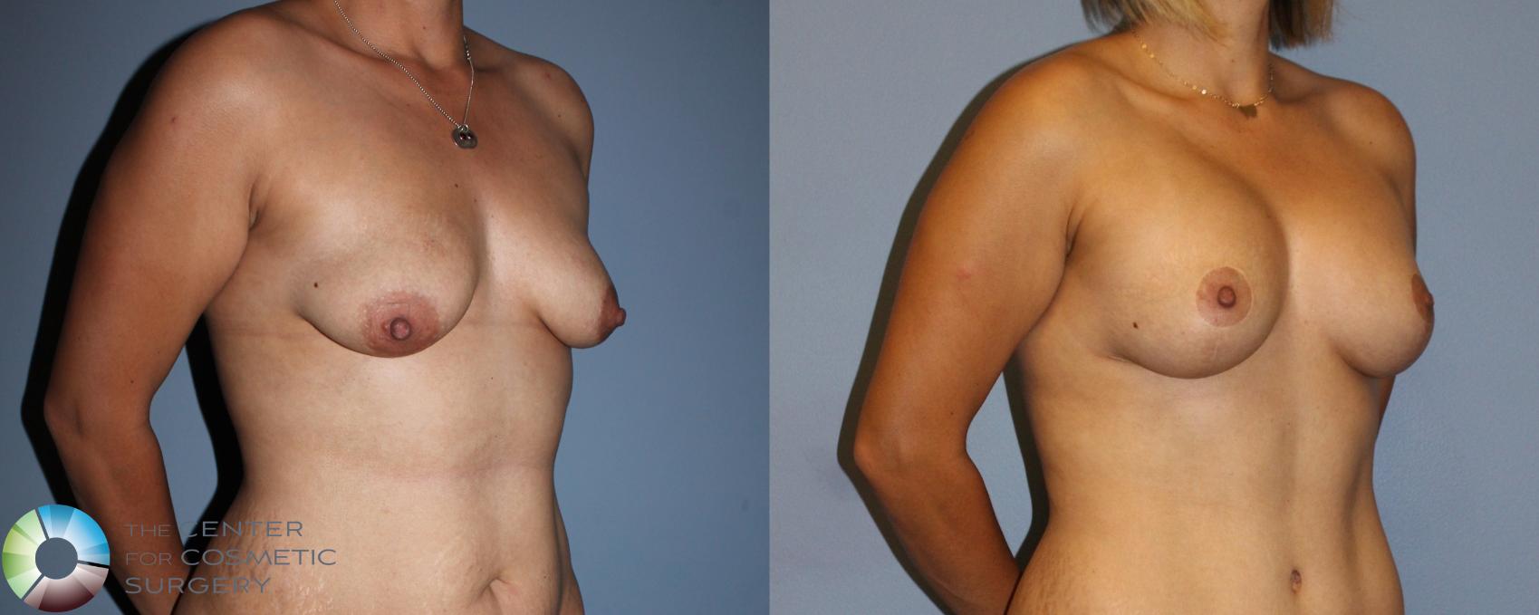 Before & After Breast Lift Case 11513 Right Oblique View in Golden, CO