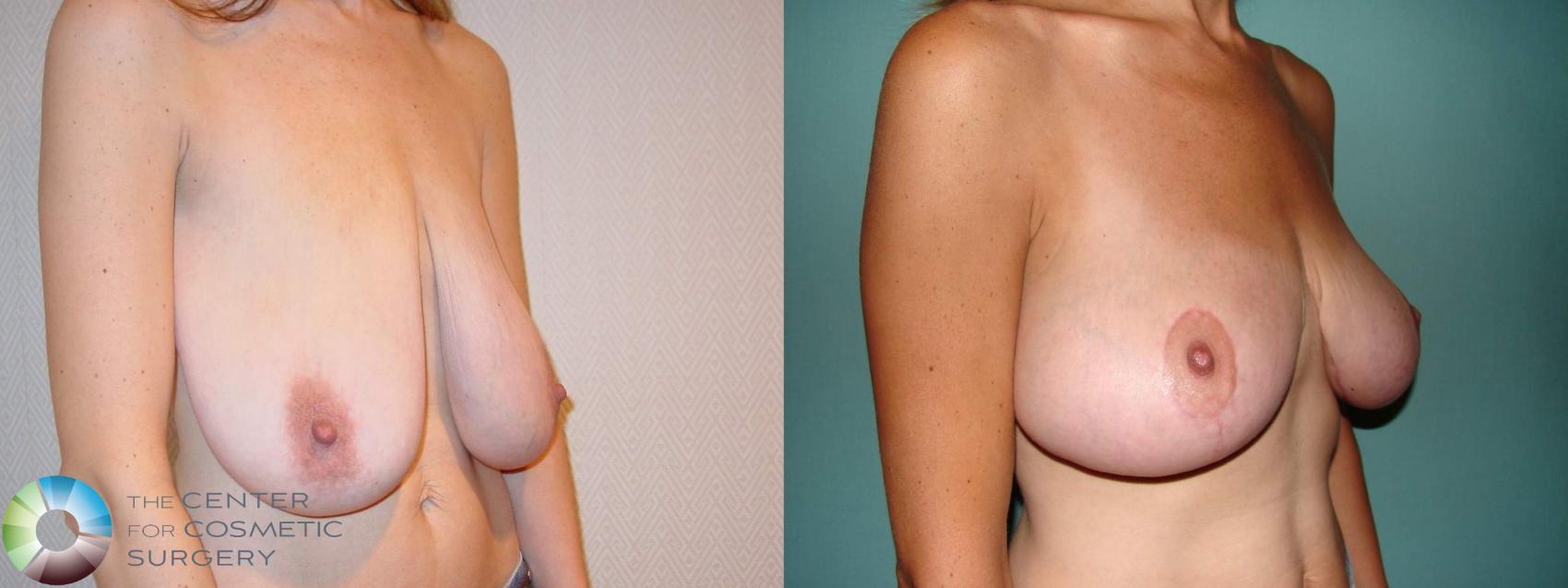 Before & After Breast Lift Case 11514 Right Oblique in Denver and Colorado Springs, CO