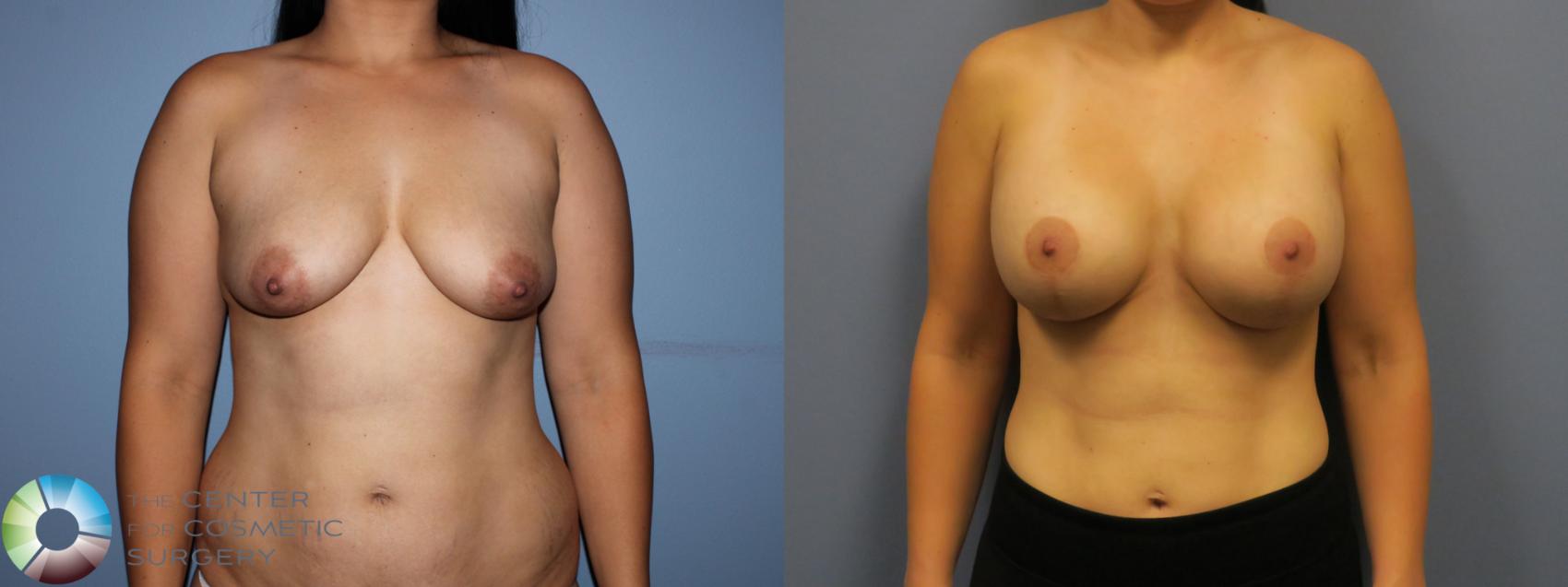 Before & After Breast Lift Case 11515 Front View in Golden, CO