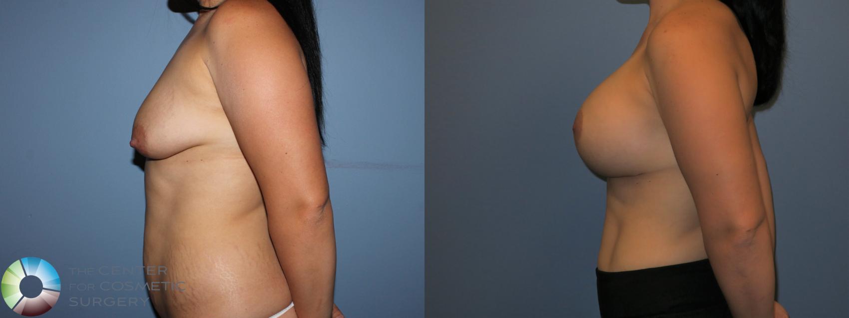 Before & After Breast Lift Case 11515 Left Side View in Golden, CO